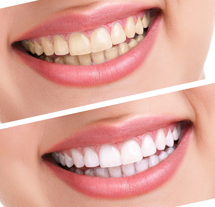 Teeth Whitening