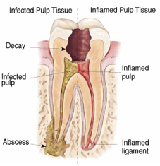 Root Canal or Extraction?