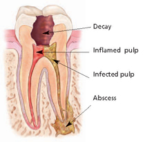 Root Canal Awareness Week