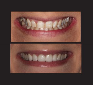 Amy S Before and After Teeth x