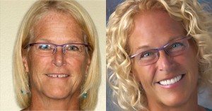 D. Stuto before and after x