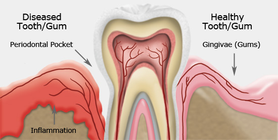 What Is Gum Disease?