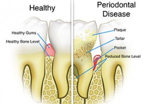 Gum Disease x