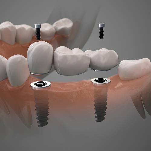 Dental Services Premier Dental Omaha Ne Cosmetic Dentistry Dental Implants Image Dental Services Premier Dental Omaha Ne Cosmetic Dentistry Dental Implants Image